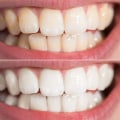 Can discolored teeth be fixed?