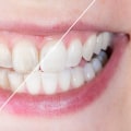 How do you fix worn enamel on your teeth?
