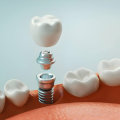 What's the most painful dental procedure?
