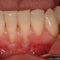 Can tooth sensitivity go away?
