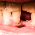 Treatments for Worn Down or Eroded Teeth Enamel