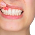 How can i prevent tooth decay naturally?