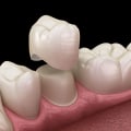 How long do crowns last?