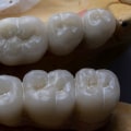 What happens during a filling?