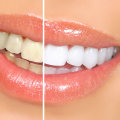 Can i get tooth bleaching using a cosmetic dental procedure?