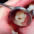 Can you stop tooth decay?