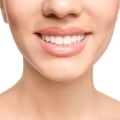 Is it possible to fill gap between teeth?