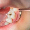 How can i tell if i have cavities?
