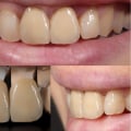 How does a tooth crown work?