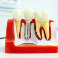 What is the most painful part of a dental implant?