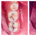 Is getting a filling painful?