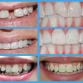 Is there another way to straighten teeth without braces?
