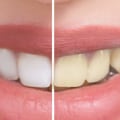 How to Safely Whiten Your Teeth at Home