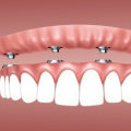 Is there a downside to implants?