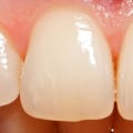 Can you restore worn enamel?
