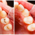 What is a filling on a tooth?