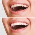 What is the purpose of a veneer?