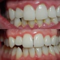Can you stop gum disease once it starts?