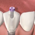 How painful is getting a dental implant?