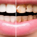 How long do veneers last for?
