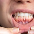 Can dentist repair receding gums?