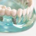 What is the best age for dental implants?
