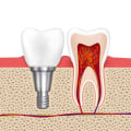 What don't they tell you about implants?