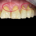 Can dentists do anything for sensitive teeth?