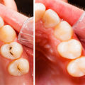 Do dentists or dental hygienists fill cavities?