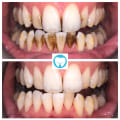 Can badly stained teeth be whitened?