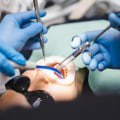 What are the most painful dental procedures?