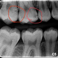 What is a dental x-ray?