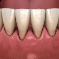 Is it ever too late to fix gum disease?