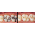 Can you 100% prevent cavities?