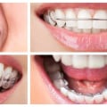 What are the different types of braces available for teeth straightening?