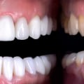 Do veneers damage your teeth?