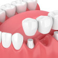 How do you fill gaps where teeth are missing?
