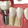 Is the first step in a dental implant painful?