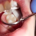How can you tell if you need a root canal?