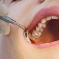 Can a dental hygienist perform a filling?