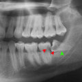 Treatments for Impacted Wisdom Teeth and Other Teeth in the Mouth