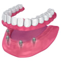 What hurts more tooth extraction or implant?