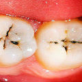 Can you stop a cavity once it starts?