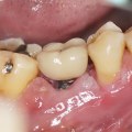 What is the downside of tooth implants?