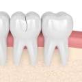 Are there any treatments available for cracked or chipped teeth?