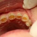 Can eroded tooth enamel be repaired?