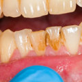 How long can you go without teeth cleaning?