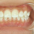 How do you fix severely discolored teeth?