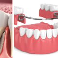 What is the best tooth replacement option?