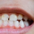 Is there a way to reverse enamel erosion?